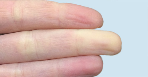 Raynaud's Phenomenon & Raynaud's Syndrome | HSS Rheumatology