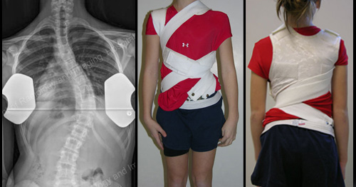 a child wearing a scoliosis brace