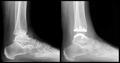 X-ray images of ankle with arthritis and ankle after total ankle replacement.