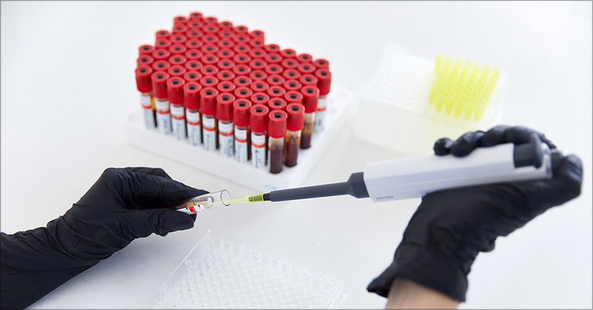 Understanding Rheumatoid Arthritis Lab Test Results | HSS