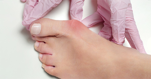 A clinician examining a patient's bunion.