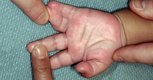 Hand of a child with syndactyly congenital hand difference.