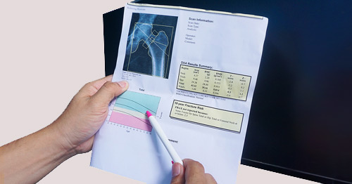 A clinician reviewing a DEXA (DXA) bone scan.