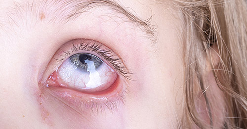 A girl with eye inflammation.