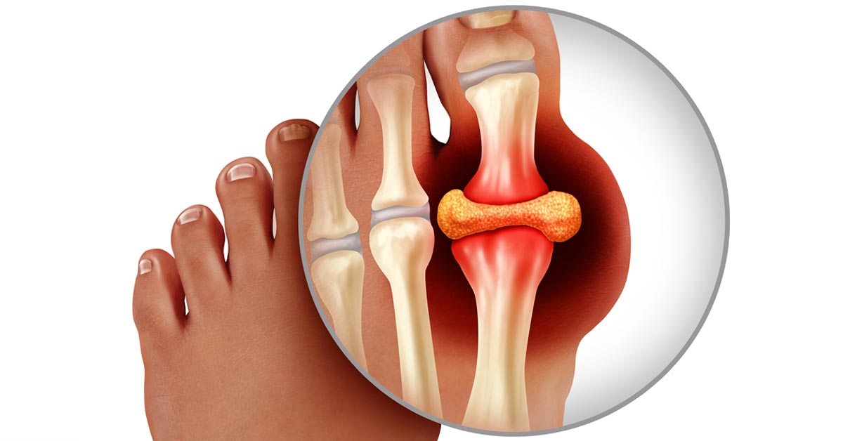 Gout (Gouty Arthritis) Risk Factors, Diagnosis and Treatment