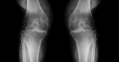 X-ray image of knees with osteoarthritis.