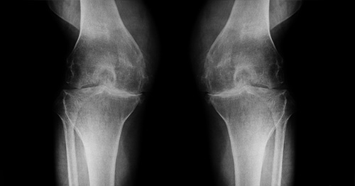 Restoring Mobility and Relieving Pain: Understanding Knee Replacement Surgery 2 knee arthritis 500X262
