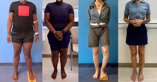 People with corrected leg length discrepancies, before and after surgery.