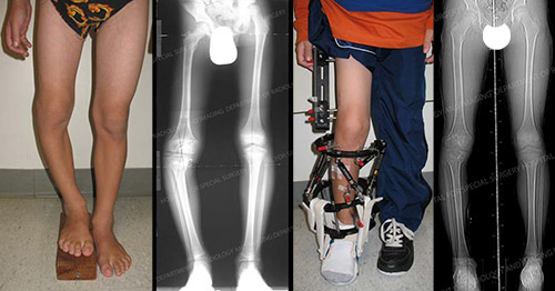 Limb lengthening in a child before and after photos and X-rays from HSS Pediatric Orthopedic Surgery.