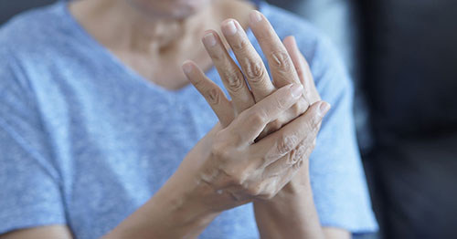 A person with rheumatoid arthritis in the hands.