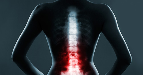 Herniated Disc (Ruptured or Slipped Spinal Disc)