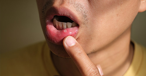 A man with a sore on the lower lip.