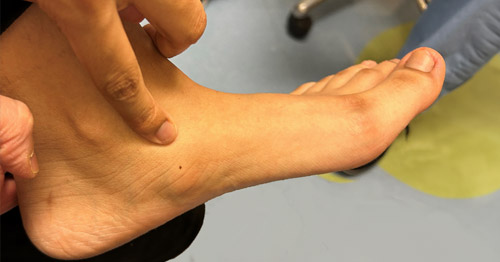 Accessory Navicular Congenital Foot Deformity Treatments