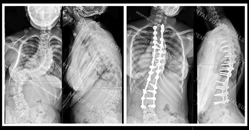 X-rays of scoliosis before and after corrective spine surgery.