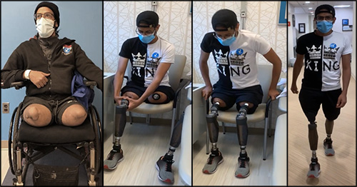 A wounded warrior double amputee demonstrates connecting and walking on his osseointegrated leg replacement prostheses.