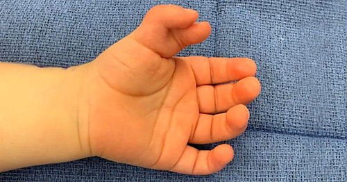 Polydactyly of the thumb (preaxial polydactyly).