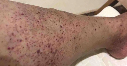 A person's leg with purpuric rash common in leukocytoclastic vasculitis.