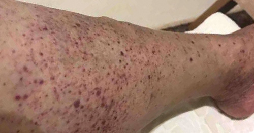 Donating Blood When You Have Lupus