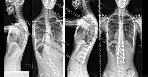 X-rays before and after scoliosis surgery.