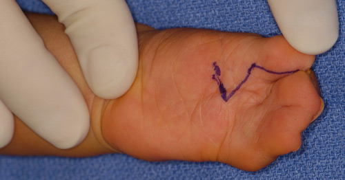 A child's hand with syndactyly being prepared for surgery.