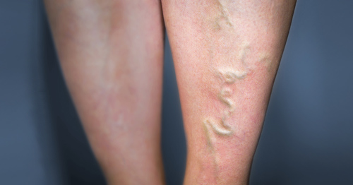 A person with thrombophlebitis on their leg.