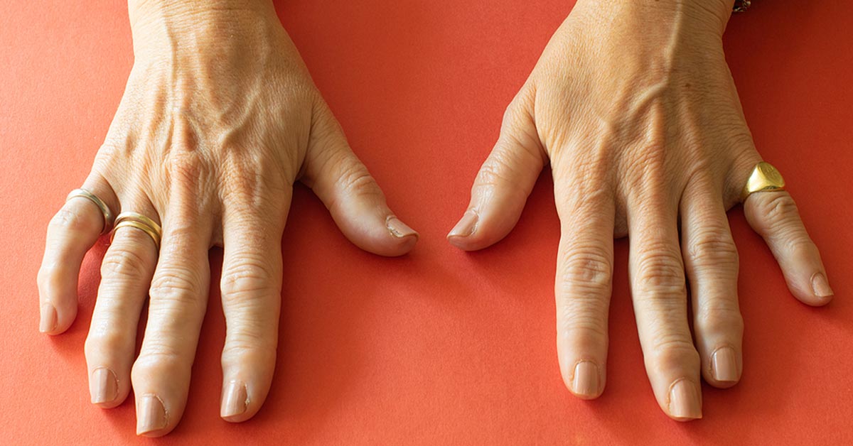 https://www.hss.edu/images/socialmedia/womans-hands-arthritis-1200x628.jpg