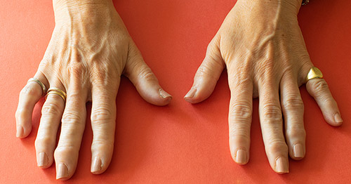 Hands of a woman with arthritis