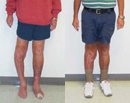 Before and After Images of Deformity Correction from Hospital for Special Surgery