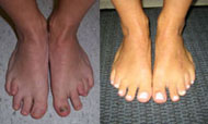 Before and After Foot Deformity Corrections from Hospital for Special Surgery