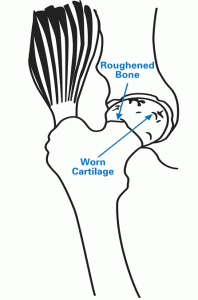 Illustration showing hip with worn cartilage