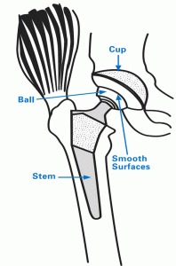 Illustration showing hip with total hip replacement