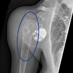 X-ray view of a chondrosarcoma (malignant bone tumor) in right proximal humerus (upper arm bone).